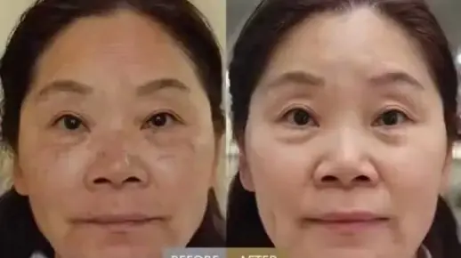 祛斑好方法，小编分享怎样快速淡斑法