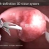 微创子宫肌瘤切除手术过程，3D演示。。