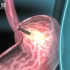 【医学双语视频】经皮内镜引导下胃造瘘术（PEG）