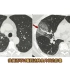 新冠肺炎CT图像分享，放射科医生讲解，收藏学习！
