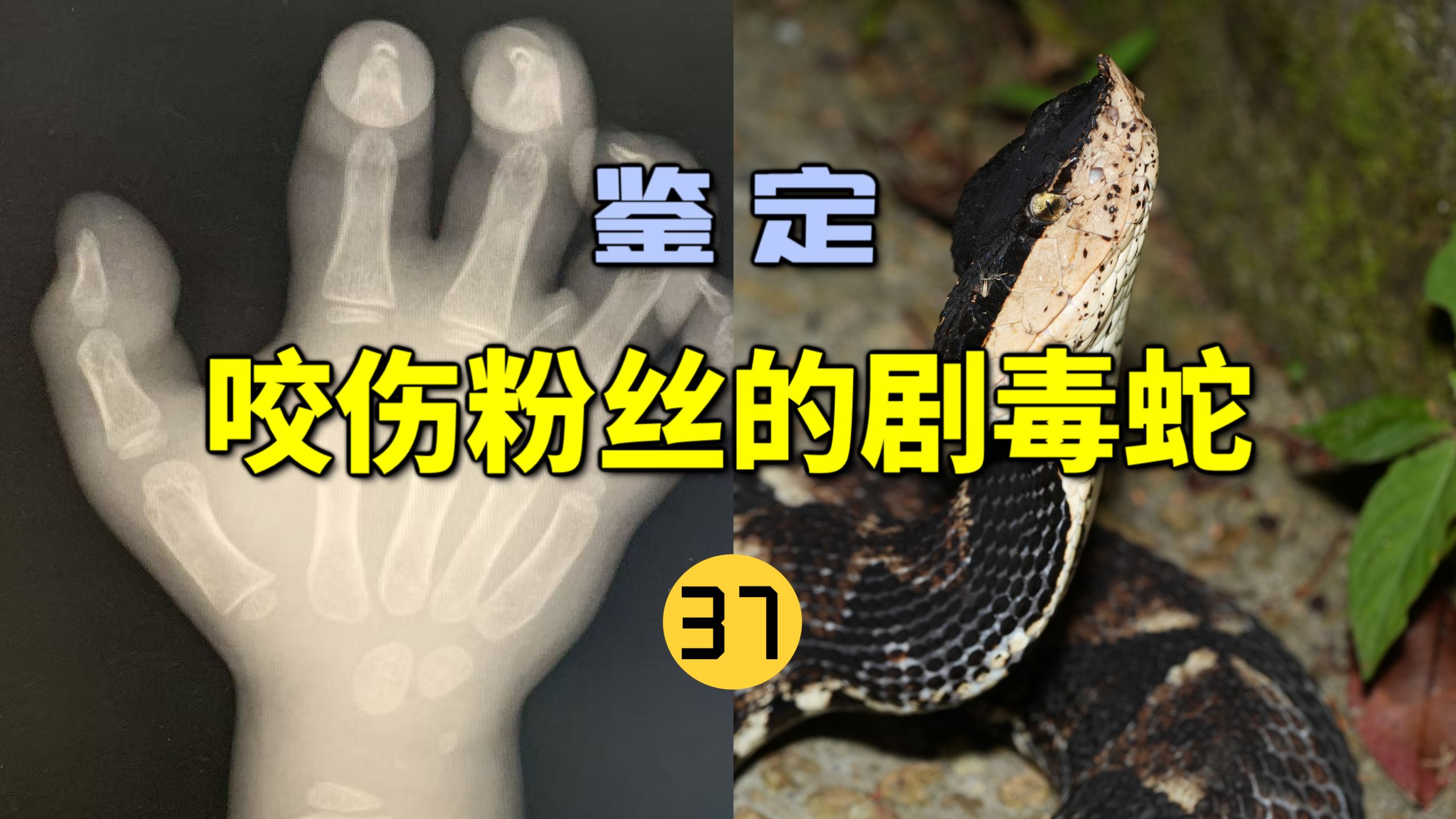 鉴定咬伤粉丝的毒蛇(37)广西一男孩被五步蛇咬伤后毒牙断在了伤口里？
