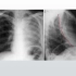 3.4.2 肺肿瘤影像学表现（二）