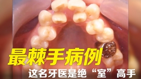 啥时候可以种牙 2c34f06a68798b4225a834e4c00556499dfe6d2a.jpg@280w_158h_1c_100q.jpg