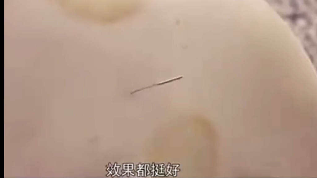 郭老膏肓天宗肩贞肩髃穴实操