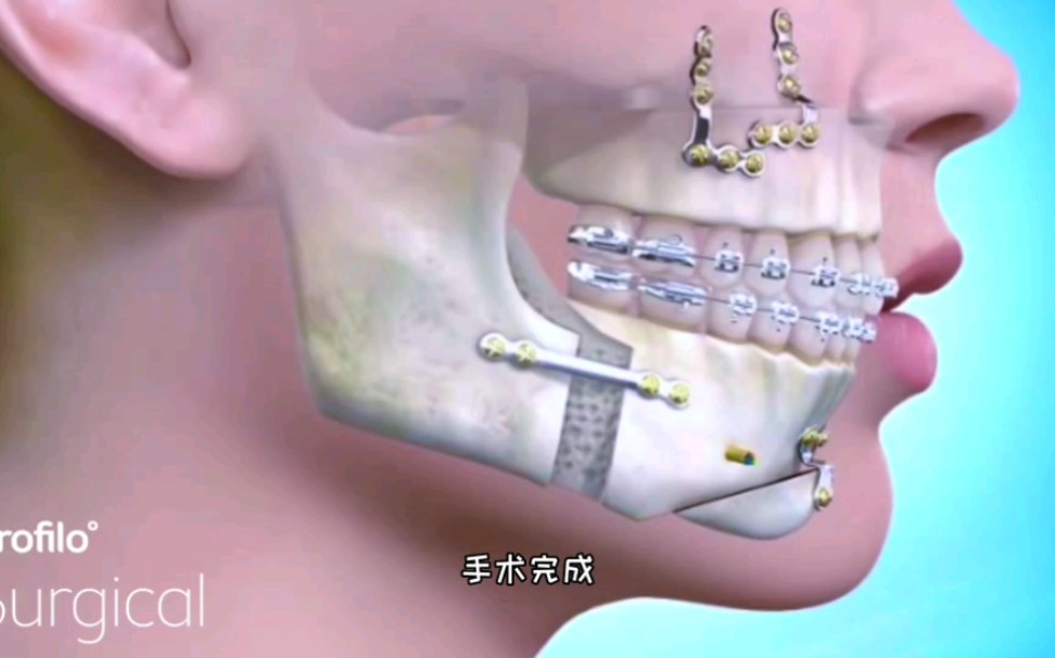这么恐怖的手术敢做吗，上下颌骨前移整形手术过程，3D演示。。