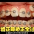 牙科医院 |牙齿正畸矫正全过程，看看牙齿神奇的变化