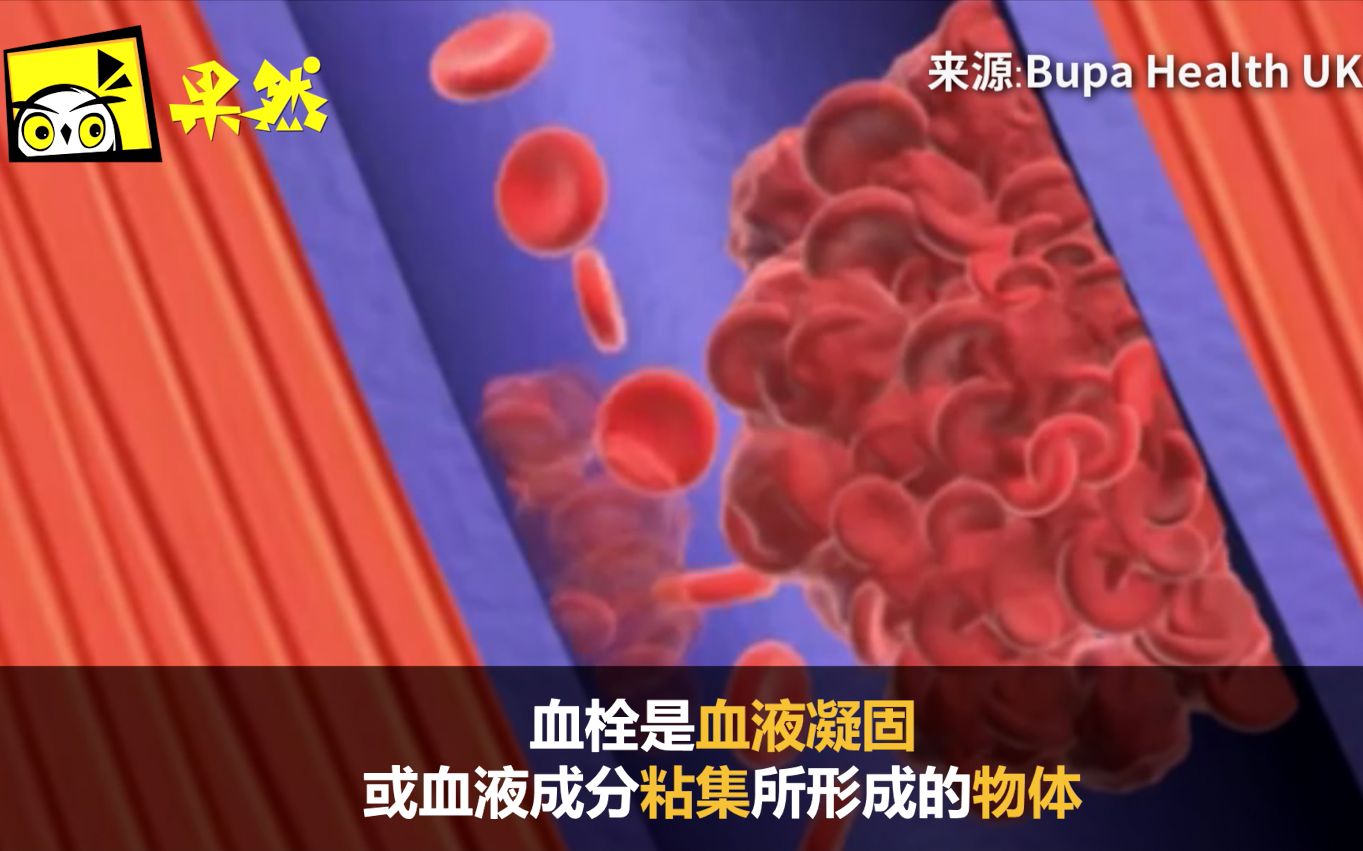 坐久了会得静脉血栓?这可不是闹着玩的!