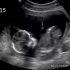怀孕40周的超声检查，从胚胎到宝宝，生命就这样诞生了！