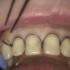 排龈线是放在您牙齿和牙龈之间，有一点点胀胀的感觉[恐惧][恐惧]