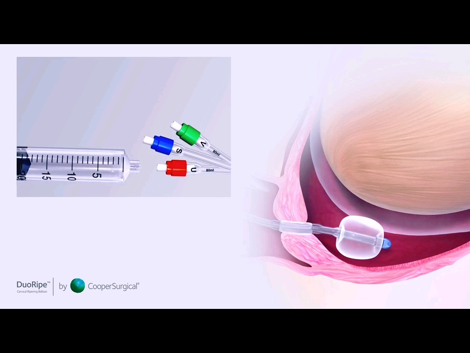 DuoRipe非药物宫颈成熟解决技术:子宫球囊+阴道球囊