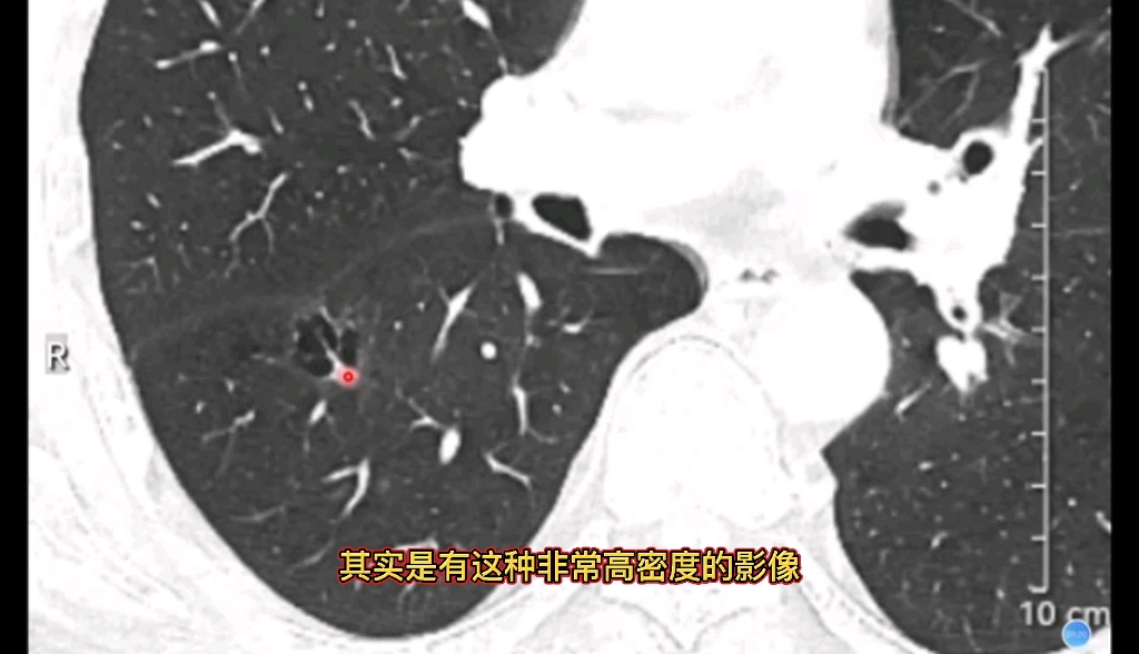 65岁男性，长期吸烟，CT发现肺部囊腔样病变，最后诊断什么？