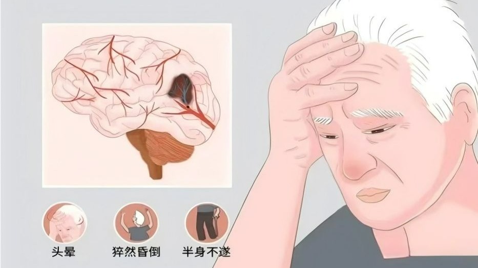神经病学——脑梗死