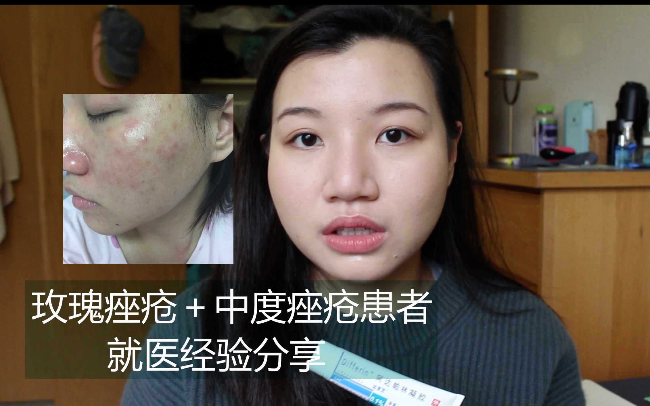 【种草的羊儿】玫瑰 中度痤疮患者就医经验分享part1