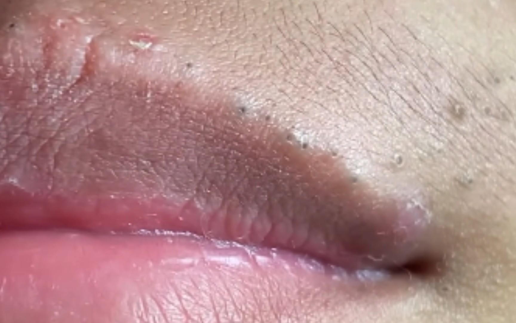 干皮肤的黑头真的好难挤！久违的唇边版！