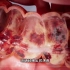 溃疡性结肠炎的病因、治疗，3D演示。。