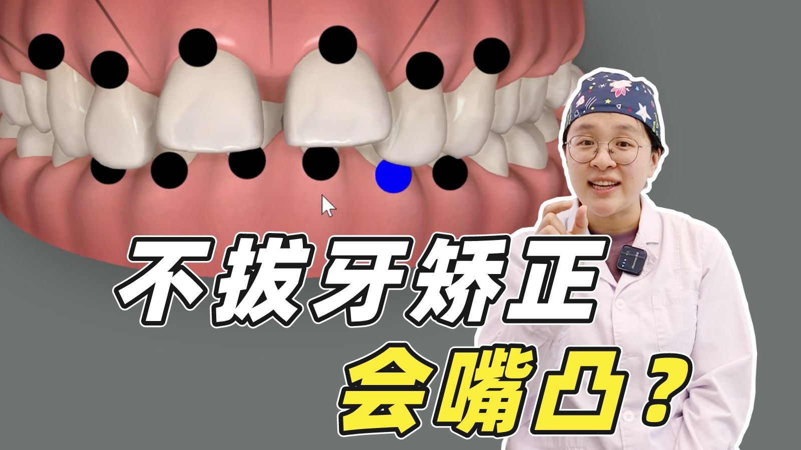 【上海九院】深覆合矫正，不拔牙一定会造成嘴凸吗？