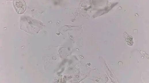 镜下鳞状上皮细胞