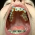 精神小伙坚持2年每天拍照，记录牙齿矫正全过程