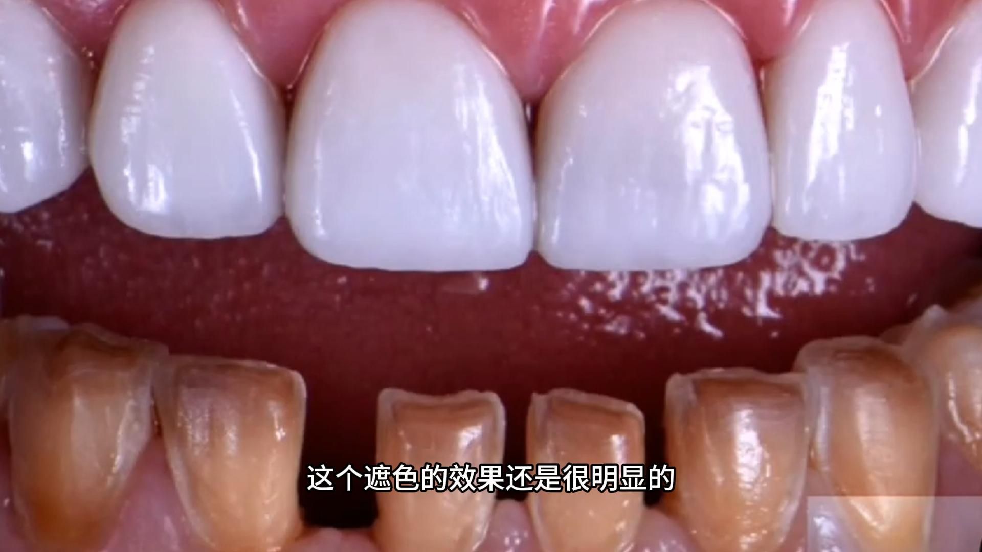 【张林】5天学会做瓷贴面2——贴面预备要点及步骤