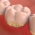 牙结石是怎么形成的？有什么危害？