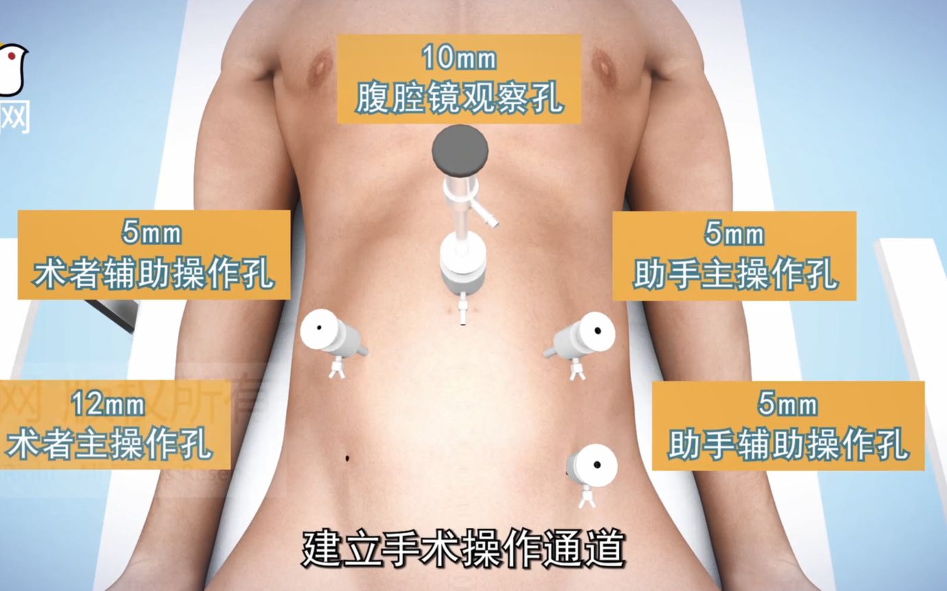 3d医学动画：微创腹腔镜手术  ·直肠癌切除手术