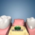 种植牙的过程，3D演示。。