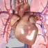 心脏房颤导致脑梗塞原因，3D演示。。