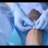 护士实操：留置针静脉输液技术。