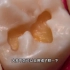 在这个视频中，你会捕捉到令人惊叹的龋齿治疗过程