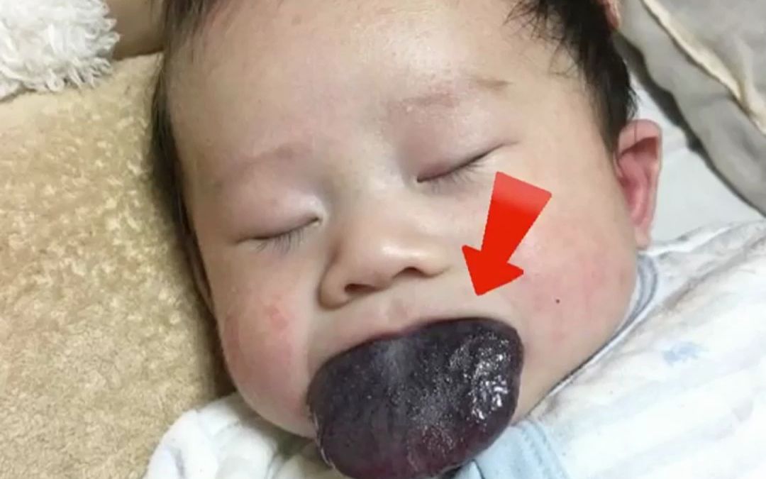 宝宝舌头肿大，到底是什么原因？