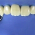 【深圳牙科】橡皮障是怎样戴到牙齿上面的呢？