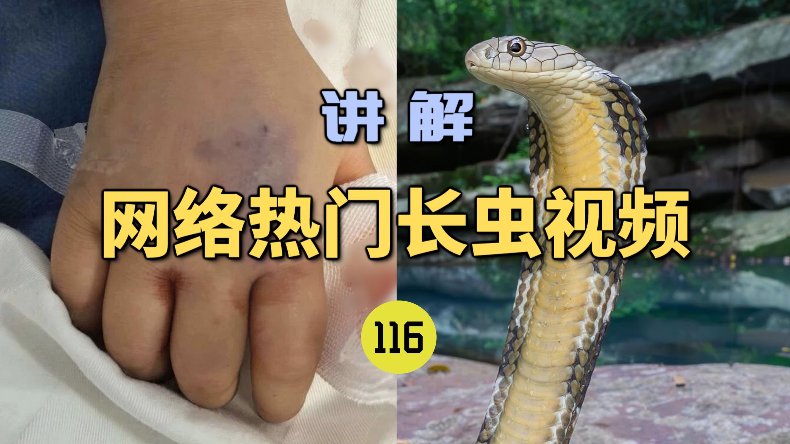 网络热门长虫视频(116)云南一3岁女童被眼镜王蛇咬伤！“假死”三天后奇迹生还？