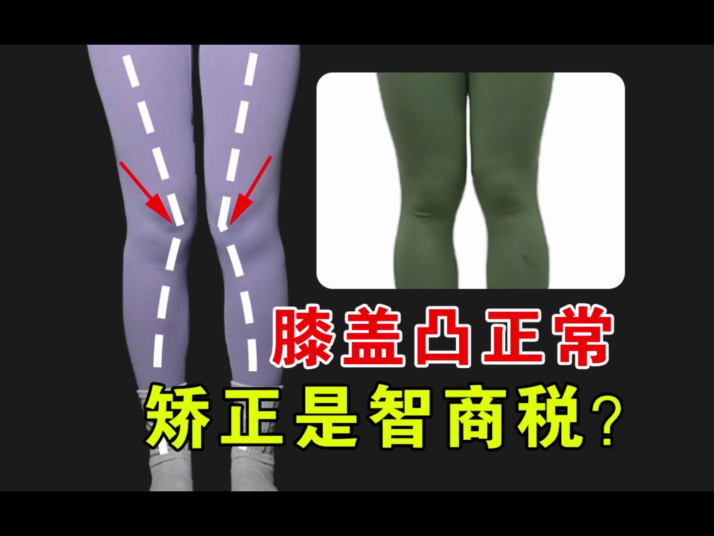 膝盖内侧凸，是制造焦虑还是体态问题？说骨头=腿型的，别忘了腿上还有肌肉、筋膜、脂肪等！