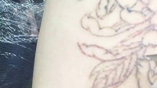超皮秒激光清洗纹身不留疤