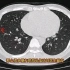 这些肺部微小结节，都是良性的，放射科医生带你认识，收藏学习