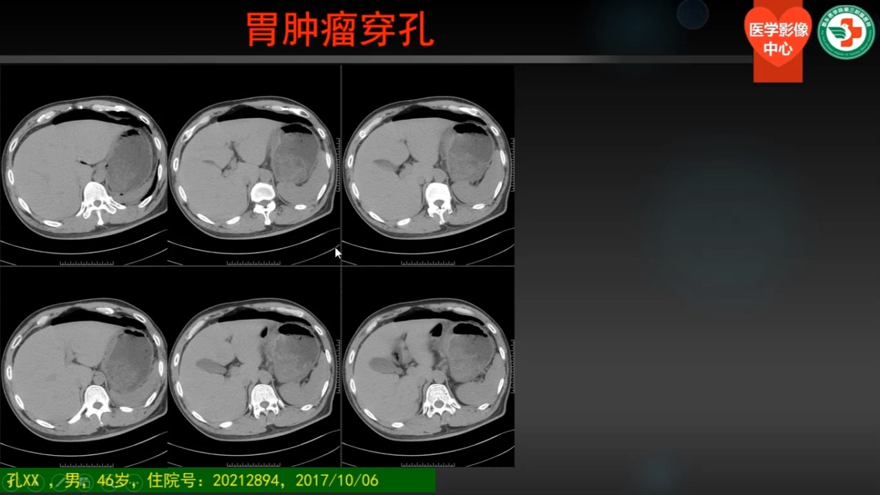 第五讲、消化道穿孔02（共30讲））