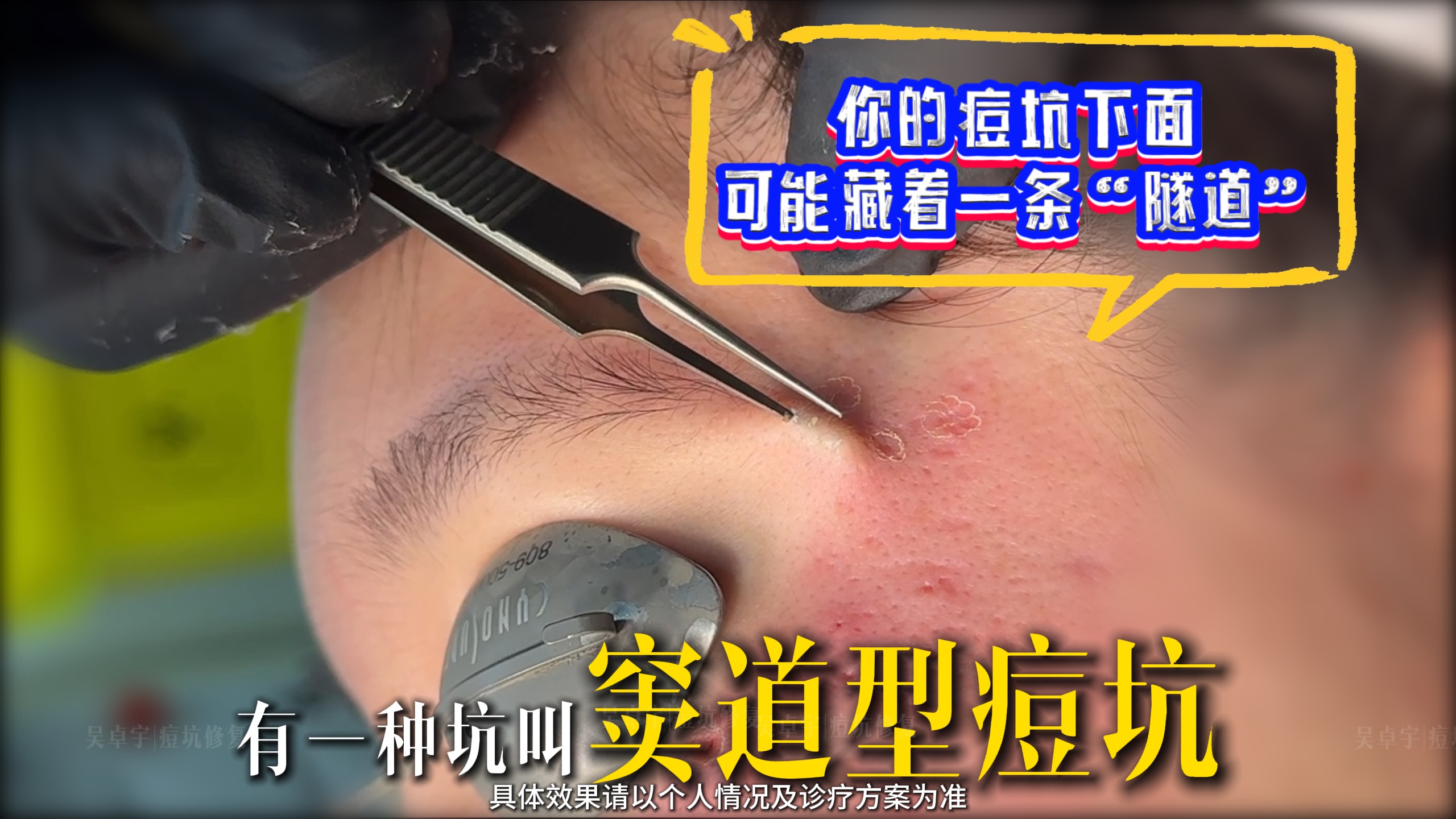 快检查一下：你的痘坑下面，可能藏着一条“隧道”