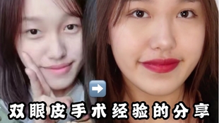 埋线双眼皮恢复30天 4a527e4c92d8d48c746ab6211de994453e7e3644.jpg@310w_174h_1c_100q.jpg
