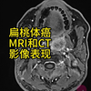 扁桃体癌/口咽癌MRI和CT影像表现