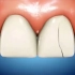 牙齿出现裂痕怎么办？