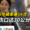 “2年被家暴16次”小谢哭诉伤口长达30公分：一年要去医院20次