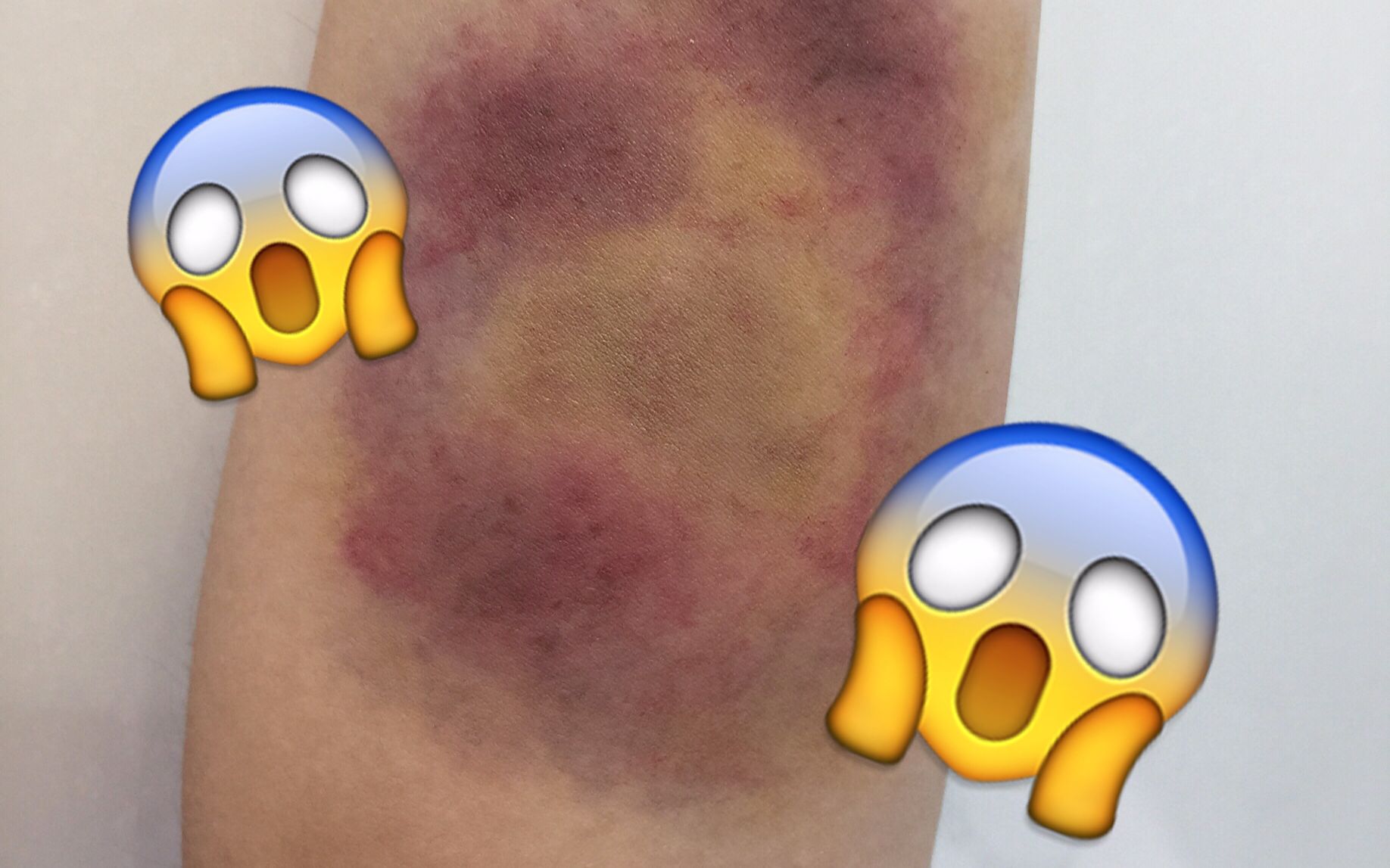 重口注意怪兽的重口味教程之淤青