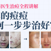 【皮肤科】全程拆解分析解说！4年多的痘痘如何治疗