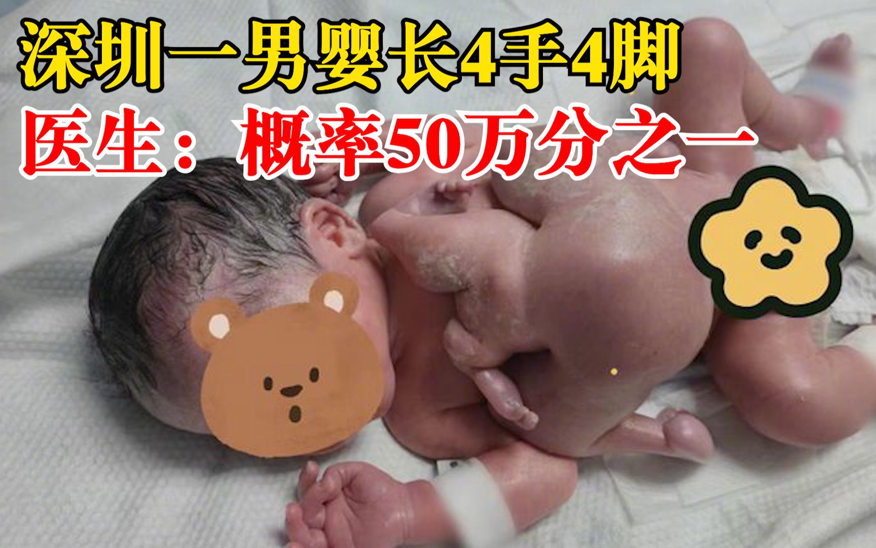 全球罕见！深圳一男婴出生时4手4脚，医生：发生概率50万分之一