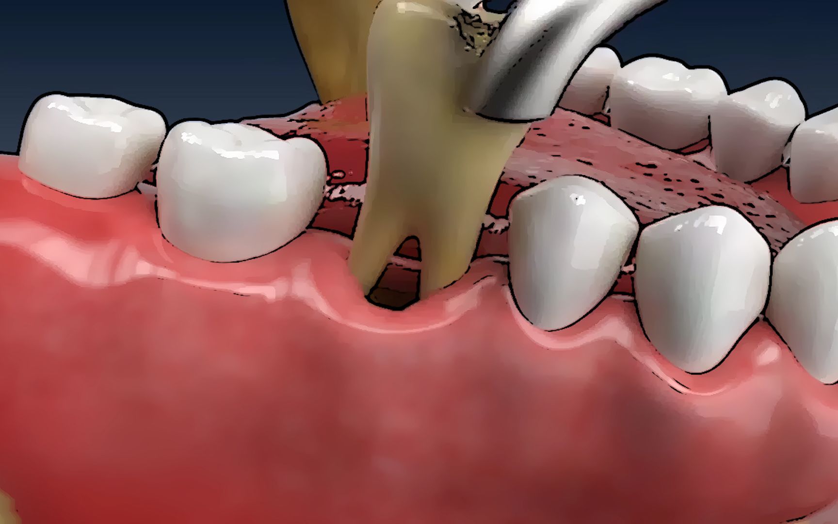 拔完牙剩下的大洞怎么办？
