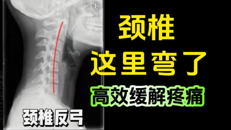 【快速缓解颈椎痛】颈椎10年患者强推！头晕、脖子反弓还有富贵包的一定要试试！