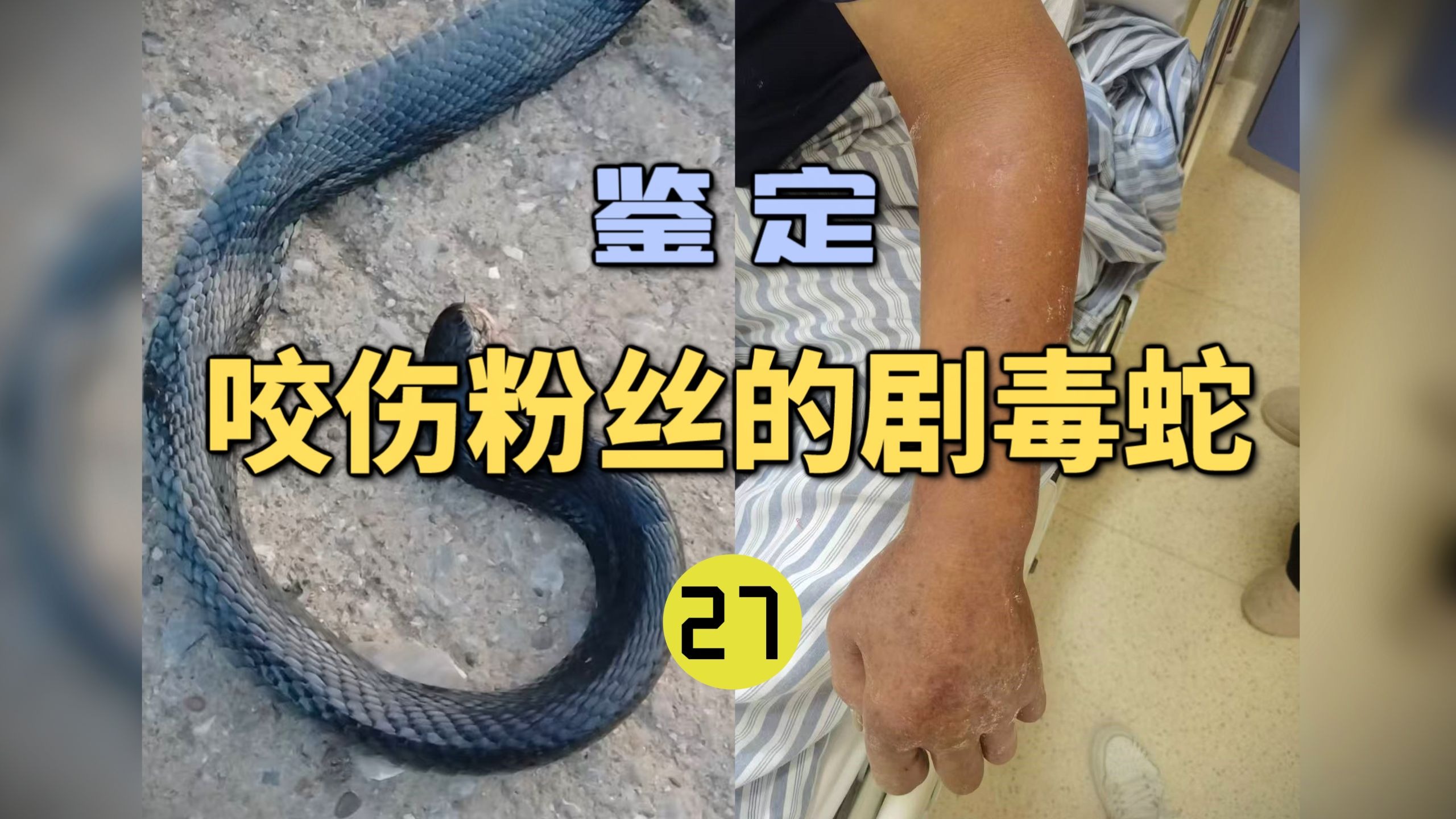 鉴定咬伤粉丝的毒蛇(27)粉丝的家人被不明毒蛇咬伤！出现严重的凝血异常！血清还打错了？-世界记忆大师龙雅-世界记忆大师龙雅-哔哩哔哩视频