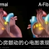 【Alila Medical Media】13.心房颤动的心电图表现