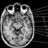 1.颅脑MRI解剖图谱-脑沟MRI解剖