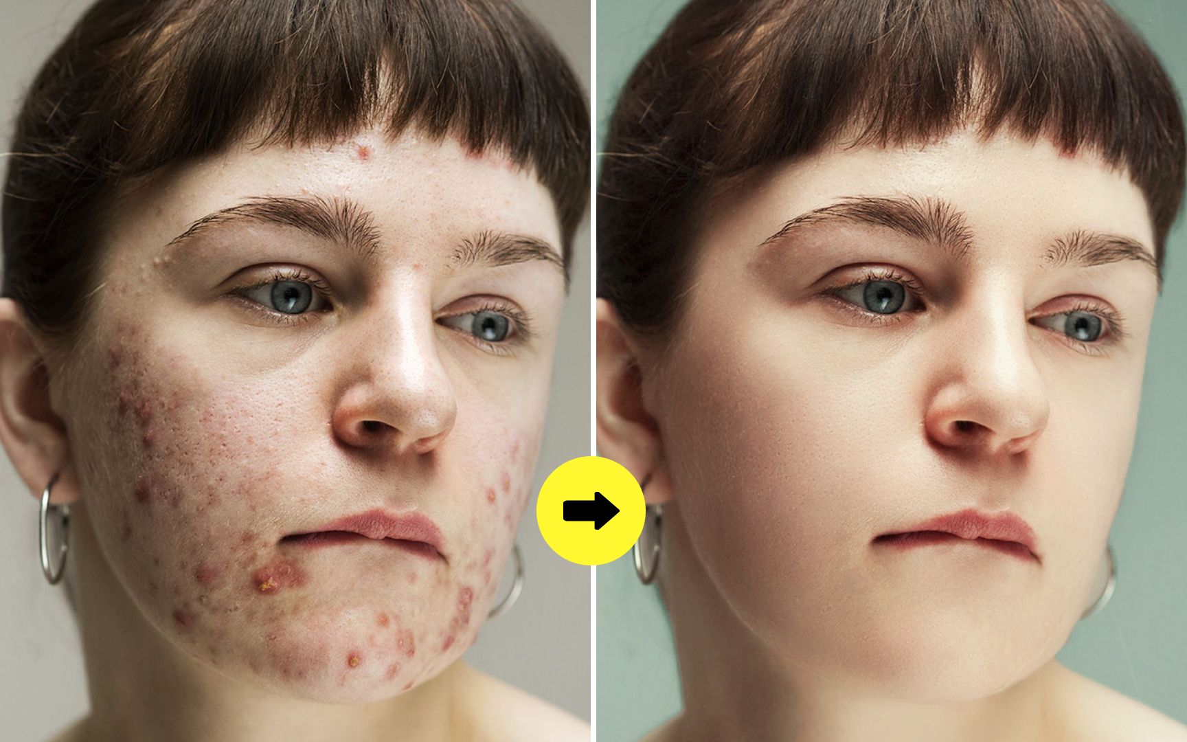 30天修复烂脸？10年痘肌分享如何祛痘修复抗炎抗敏 | 后背祛痘神器 |_哔哩哔哩_bilibili
